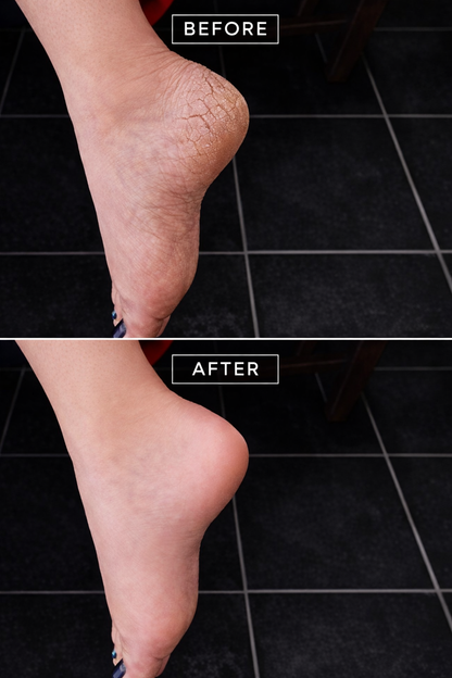 ✨CartsySA™ Electric Foot Callus Remover
